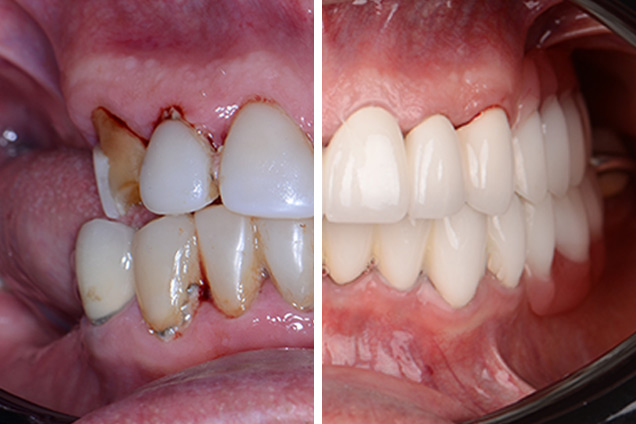 Коронки та протези