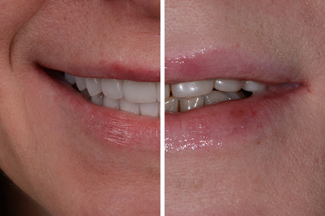 Коронки + вініри