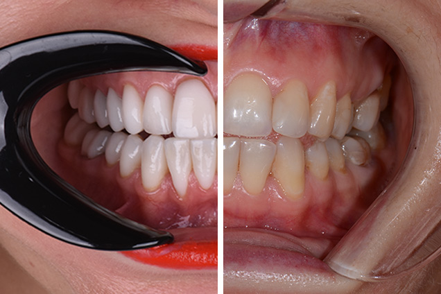 Брекети + вініри