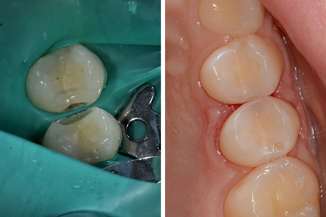 Лікування карієсу