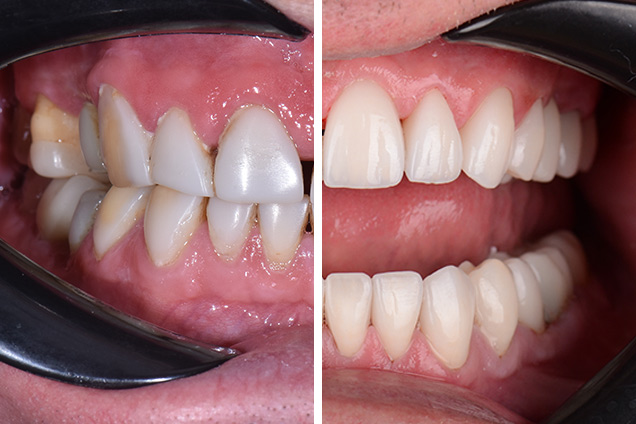 Коронки та протези